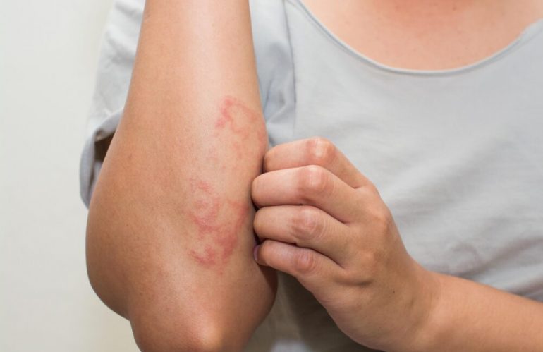 ¿Qué es la dermatitis nerviosa?